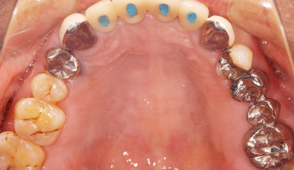前歯を４本失った症例：治療後