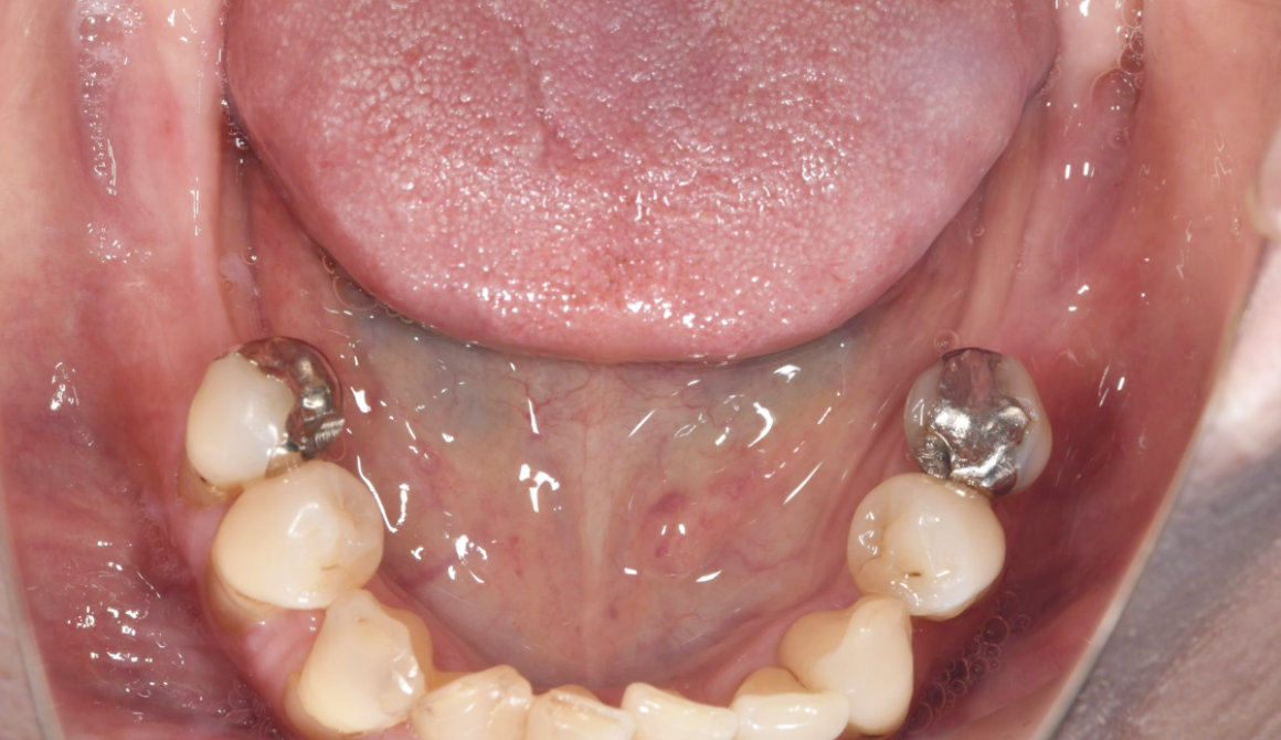 奥歯を４本失った症例：治療前